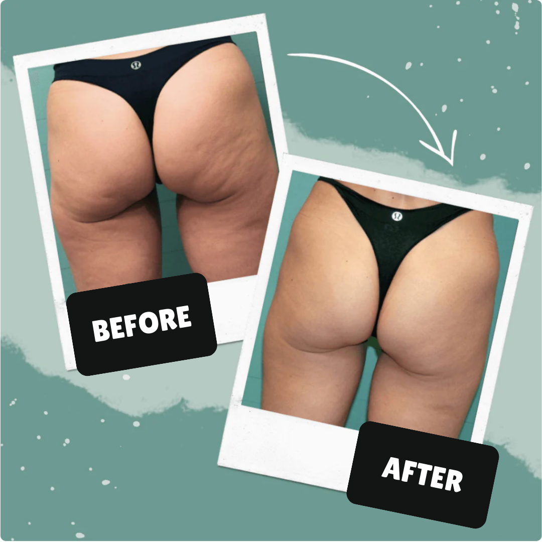 CelluPro™ - Anti-Cellulite Body Massages